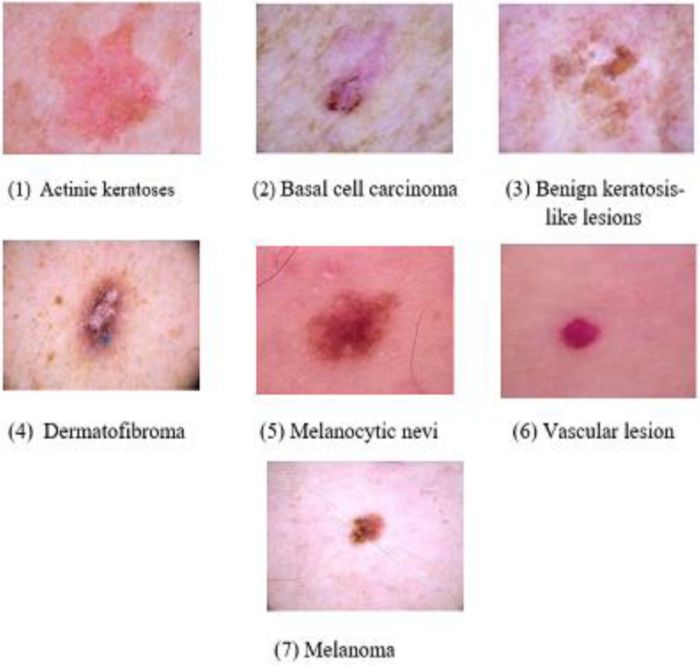 One benign lesion measuring 0.5 cm